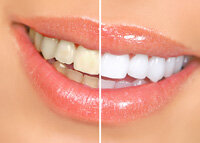 before and after results professional teeth whitening Joliet, IL